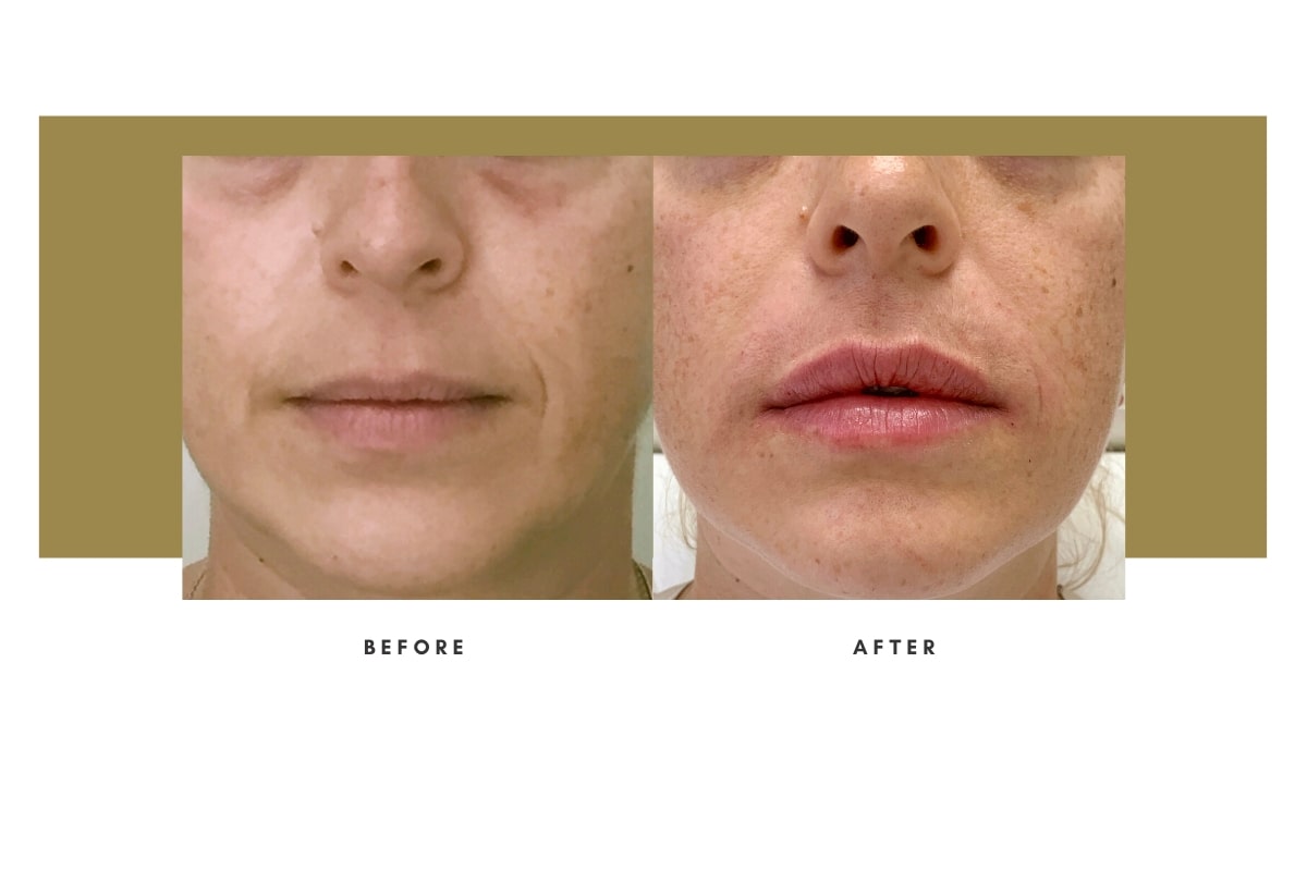 Injectable Filler - Before / After