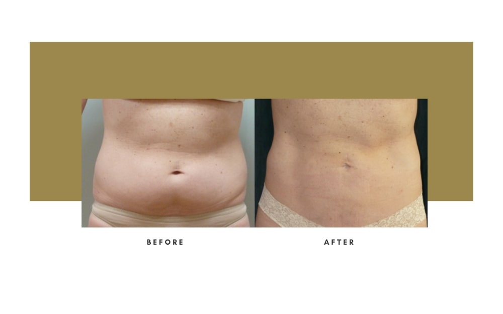 Liposuction Before and After 3