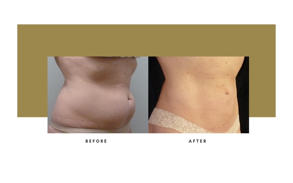 Liposuction Before and After 4
