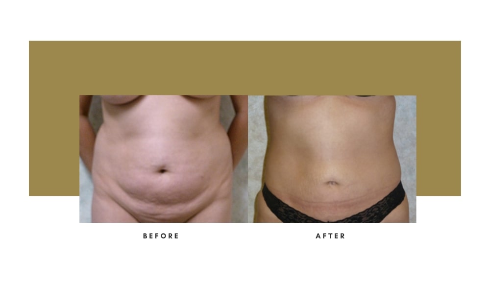 Liposuction Before and After 5