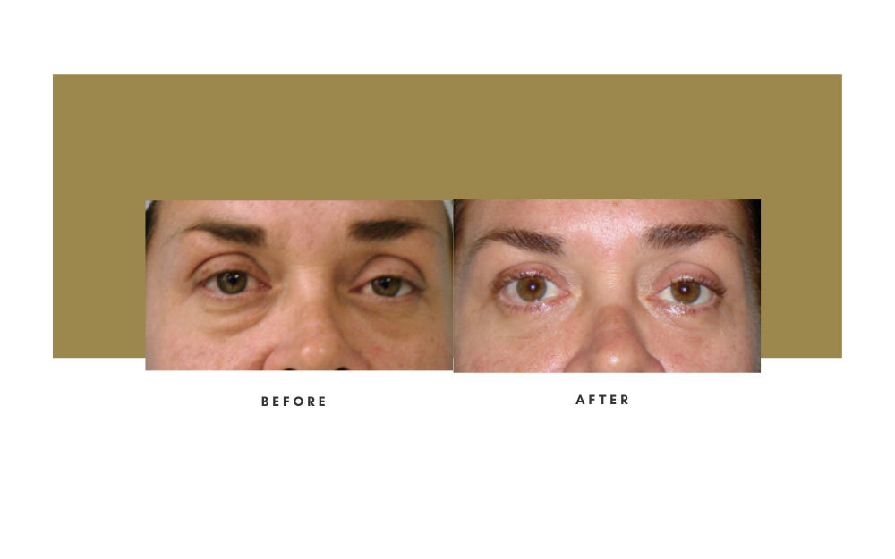 Lower Blepharoplasty Before and After 3