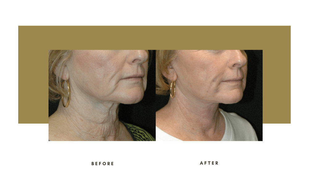 Necklift Before and After