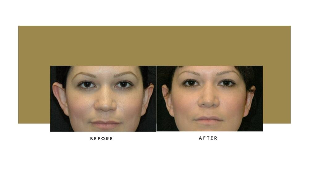 Otoplasty Before and After 1