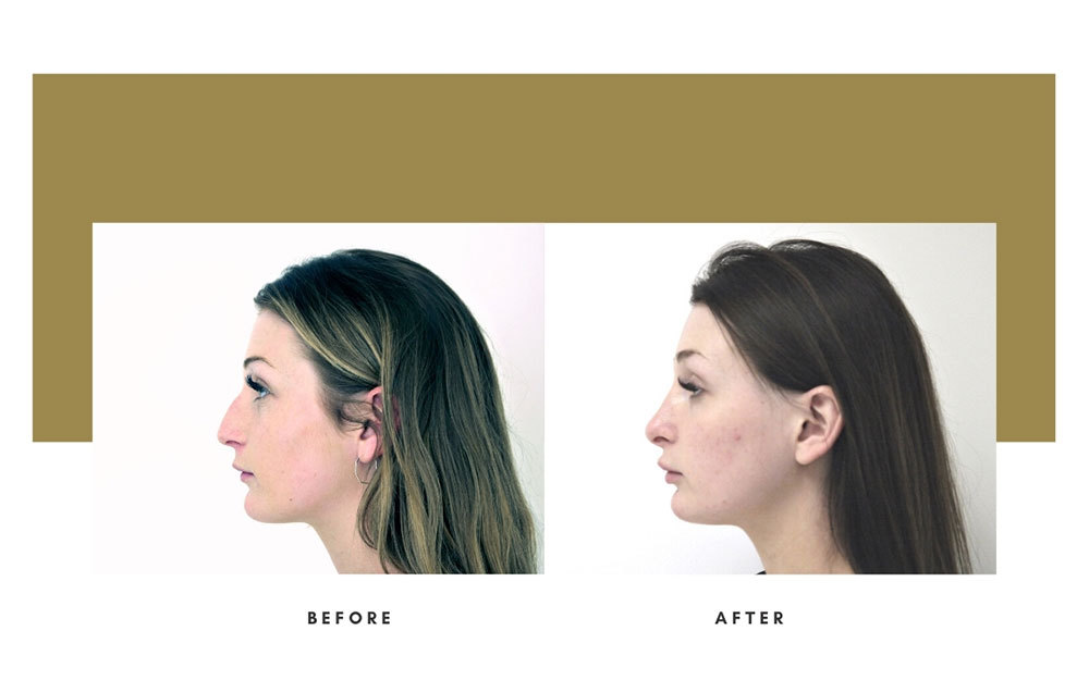 Rhinoplasty Before / After Case 21