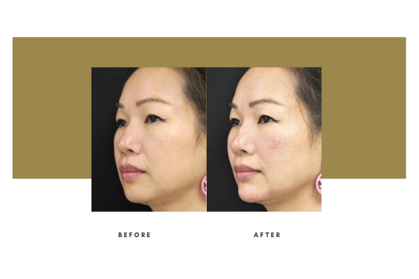 Facelift Before / After