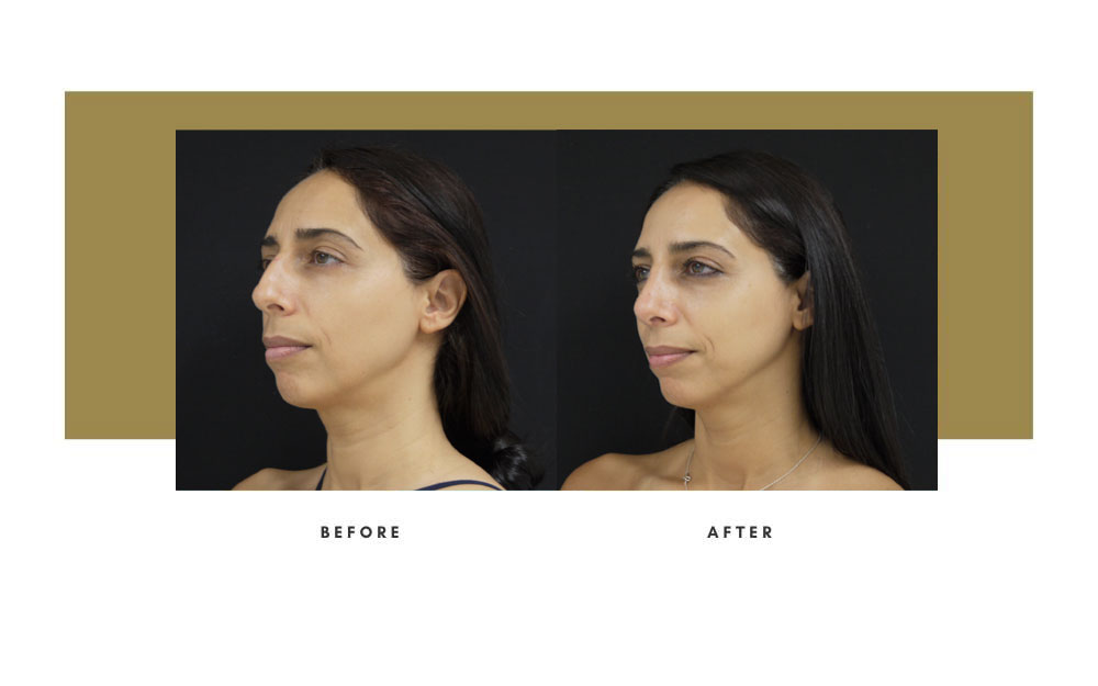 Rhinoplasty Before / After Case 18