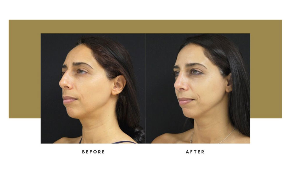 Rhinoplasty Before / After Case 16