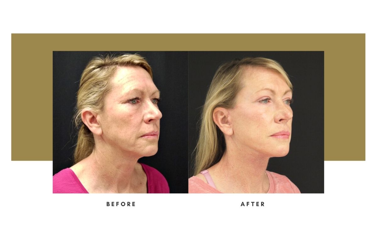Facelift Before / After