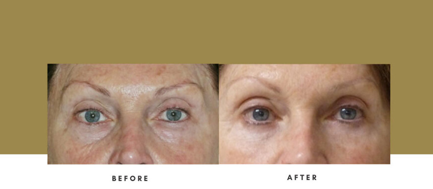 Eyelid Surgery