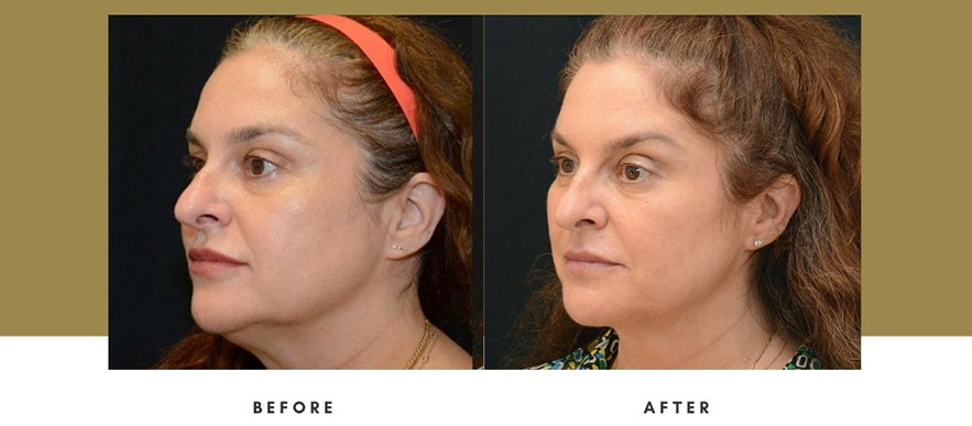 Morpheus8 FaceTite Before and After